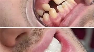 لمینیت دو فک