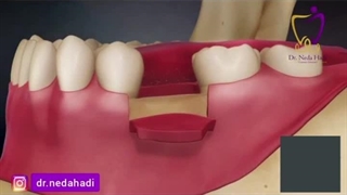آشنایی با روش ایمپلنت دندادن ..
