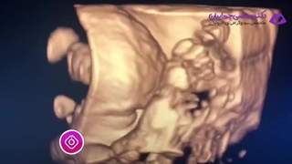 سونوگرافی ســـه بعـــدی