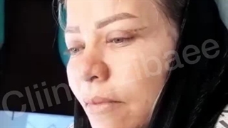 بلفاروپلاستی پلک بالا