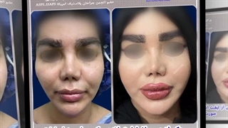 یکماه پس از لیفت آندوسکوپی ابروها و لیفت صورت و گردن