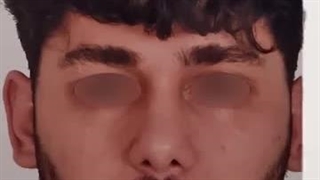 جراحی زیبایی اتوپلاستی