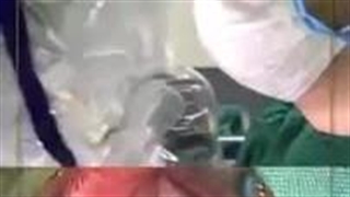 〽️اصلاح اختلال گفتاری به علت شکاف کام