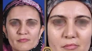 جراحی رینوپلاستی در بیماران شکاف لب