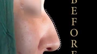 جراحی بینی استخوانی