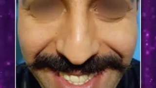 . جراحی بینی برای زیباجو عزیز