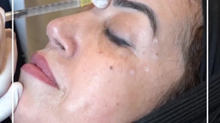 بوتاکس  یک عمل زیبایی است که مرکز زیبایی شادمهر دارای کادر باتجربه و مسلکی را در این ضمینه دارا میباشد