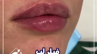 تزریق ژل لب . بوتاکس .ژل و انواع کارهای زیبایی فقد با مرکز زیبایی شادمهر