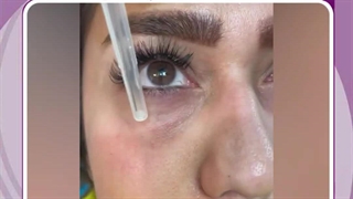 رفع گودی زیر چشم