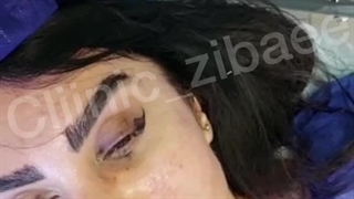 جراحی لیفت سانترال لب