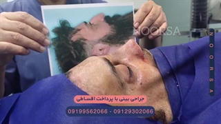 جراحی بینی اقساطی