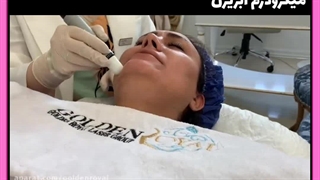 میکرودرم آبریژن دندان شیری