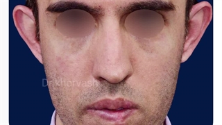 یکسال پس از عمل زیبایی بینی و گوش