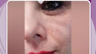 فیلر زیر چشم