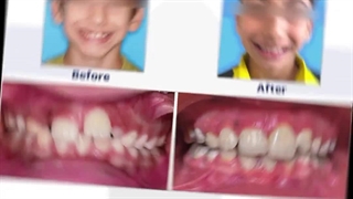 درمان انحراف شدید دندانها با ارتودنسی متحرک