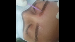 ریمو حرفه ای تاتو رشت