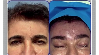 لیفت آندوسکوپی ابروها و پیشانی