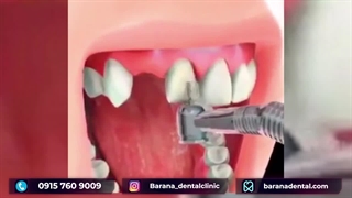 پروتز دندان