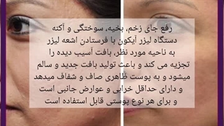 لیزر آیکون برای جای جوش کربوکسی تراپی