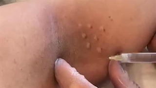 بوتاکس زیر بغل