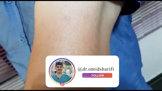 در رفتگی و پارگی آرنج