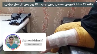 تعویض مفص زانو خانم 61 ساله