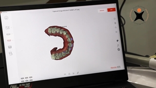 اسکنر داخل دهانی آمریکایی 3Disc Heron IOS