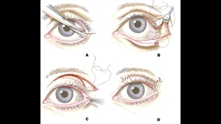جراحی پلک چیست؟