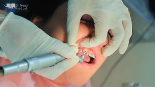 ارتودنسی فانکشنال دو مرحله ای کودک