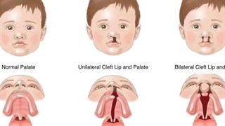 درمان ارتودنسی شکاف کام