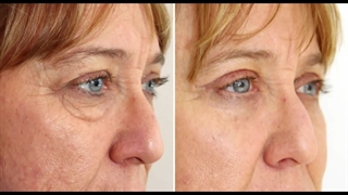 جراحی پلک بالا و پایین