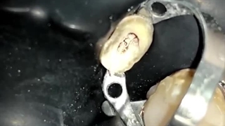 بهترین نحوه سمان کردن فایبر پست : آموزش کامل و گام به گام