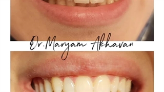 نمونه درمان اصلاح طرح لبخند باکامپوزیت ونیر