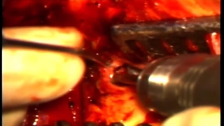 کلستئوتوما