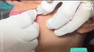گذاشتن یک واحد مینی اسکرو - دکتر نیلوفر آزاده - متخصص ارتودنسی کلینیک لیزر