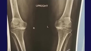 درمان آرتروز پیشرفته زانو با تعویض کامل مفصل | دکتر طاهریان