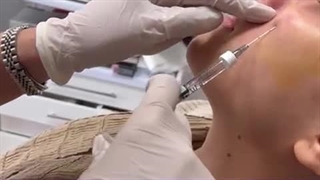 فیلم تزریق فیلر زیر چشم