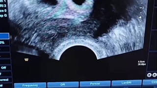 تعیین جنسیت IVF دوقلویی
