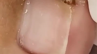 جراحی ناخن فرو رفته در پا