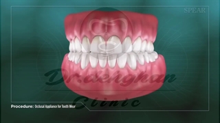 دندان قروچه