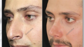 جراحی بینی با قوز و افتادگی شدید نوک بینی