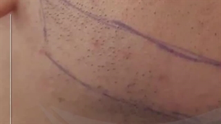 کــاشــــت ریــــش