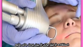 لیزر برای جای بخیه ترمیم زیبایی دندان