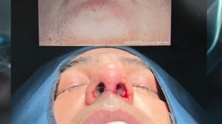 چالش اتاق عمل، جراحی بینی مردان