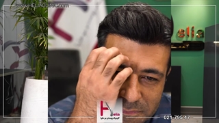 نتایج شگفت‌انگیز کاشت مو با میکروگرافت در کلینیک هلیا