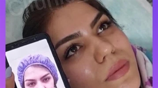 لیفت گونه با جراحی در کلینیک آرتین