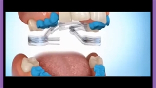 کامپوزیت بهتره یا ارتودنسی میکرونیدلینگ