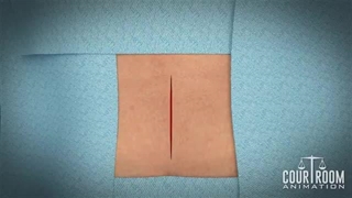 جراحی دیسککتومی کمر: انیمیشن پزشکی