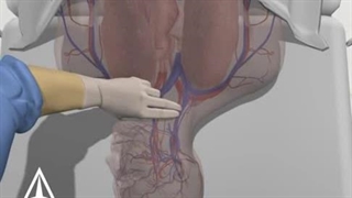 رویه خط مرکزی - انیمیشن پزشکی سه بعدی