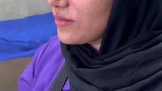 سه ماه پس از عمل راینوپلاستی به صورت نیمه فانتزی | دکتر جانی پور